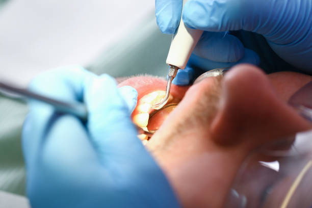 Best Emergency Dentist for Lost Fillings or Crowns in Munsey Park, NY