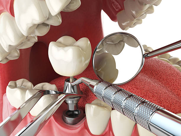 Best Emergency Root Canal Treatment in Munsey Park, NY